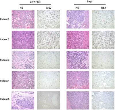 Clonal Evolution Dynamics in Primary and Metastatic Lesions of Pancreatic Neuroendocrine Neoplasms